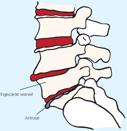 Artrose zenuwbeklemming! | Chiropractie van Beest