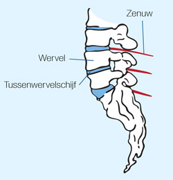 ischias zenuw, wervel, tussenwervelschijf