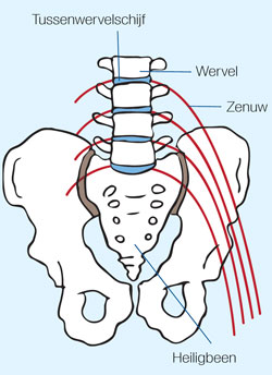 ischias zenuw, wervel, tussenwervelschijf, heiligbeen