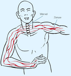 Chiropractie nek schouder en armpijn anatomie
