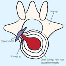 Hernia behandelen anatomie