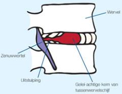 Oorzaak hernia en behandelen