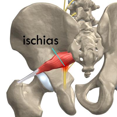 Beenpijn wordt veelal veroorzaakt door een irritatie van de ischias zenuw